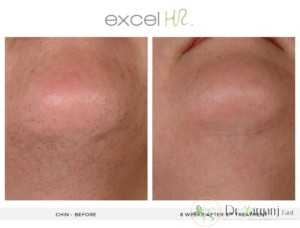 لیزرهای دایود برای بر طرف کردن موهای زائد چگونه کار میکنند؟
