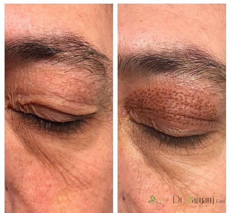 روش کار پلکسر چگونه است؟