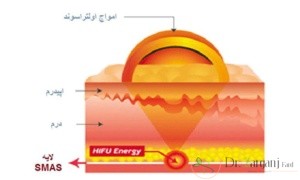اولتراپی (Ultherapy) :