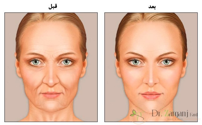 مزایای ژل تزریقی: