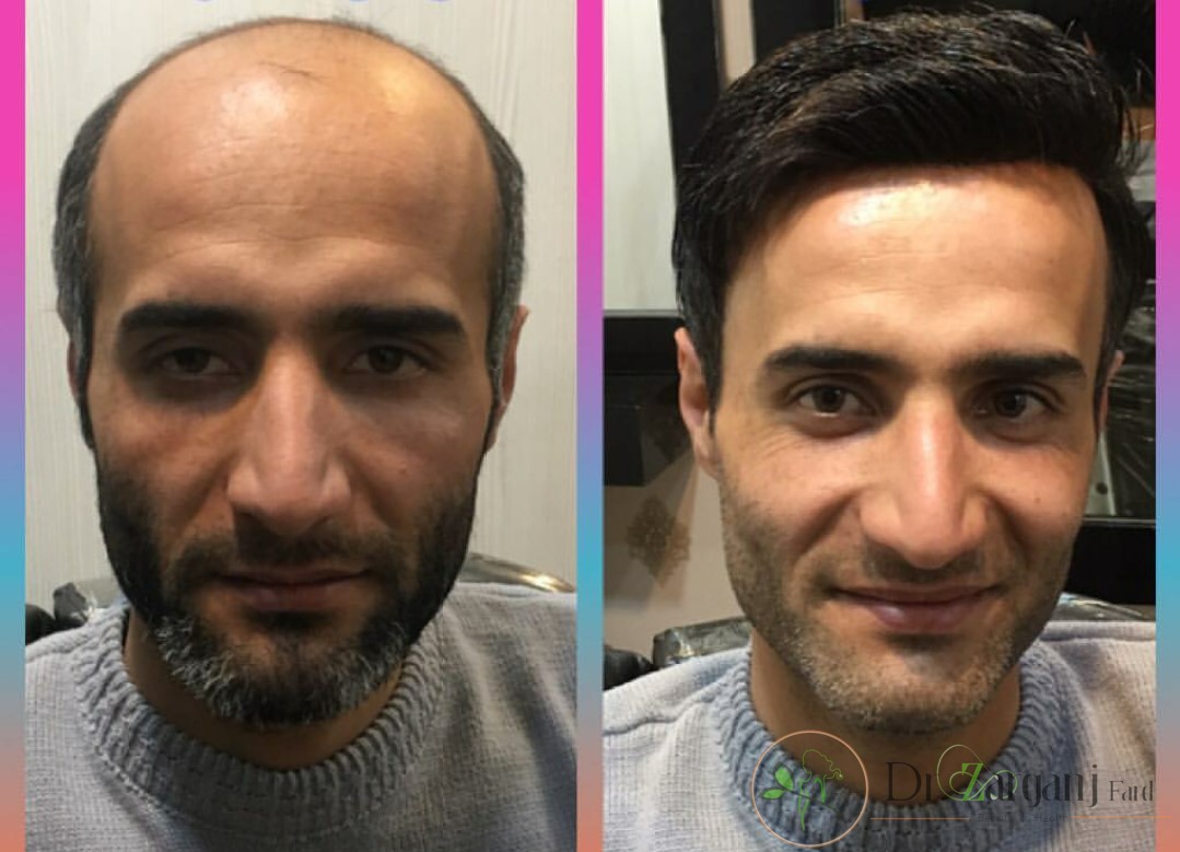 کاشت مو در این کلینیک چگونه صورت می گیرد؟