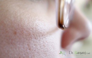فرایند درمان منافذ باز پوست در چند مرحله صورت میگیرد؟