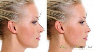 افرادی که می توانند تزریق ژل بینی را انجام بدهند