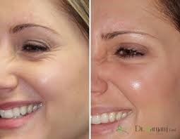 بعد از تزریق ژل باید چه نکاتی را رعایت کنیم؟