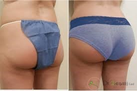 هزینه تزریق چربی باسن