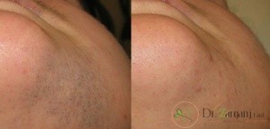 راه حل برای موهای زائد