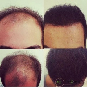 2.درباره کاشت مو در کلینیک زیبایی دکتر زرگنج چه اطلاعتی دارید؟