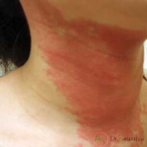 لیزر کردن مو چه خطراتی می تواند داشته باشد؟