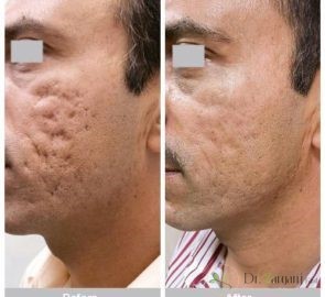 انواع جای جوش