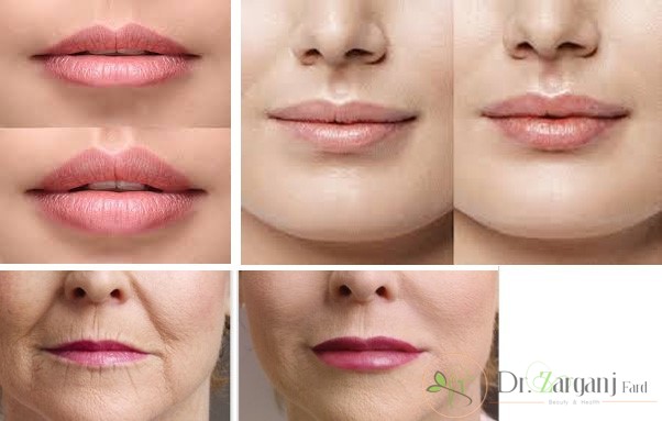 عوارض روش ژل تزریقی: