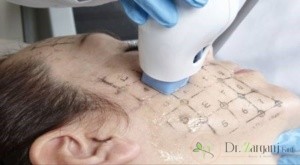 فرکشنال رادیو فرکوئنسی (Needle RF) :