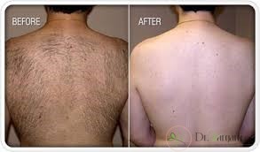 روند درمان لیزر مو های زاید بدن چگونه است؟