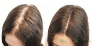 مزوتراپی مناسب کدام دسته از افراد است؟