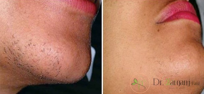 توصیه های پزشکی برای نگهداری از پوست قبل از لیزر چیست؟