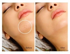 حذف موهای زائد چه نقاطی از بدن با لیزر امکان پذیر است؟