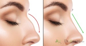 کاربرد تزریق ژل بینی