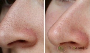 وجود منافذ باز، در پوست انسان چه مشکلاتی را میتواند در پیش داشته باشد؟