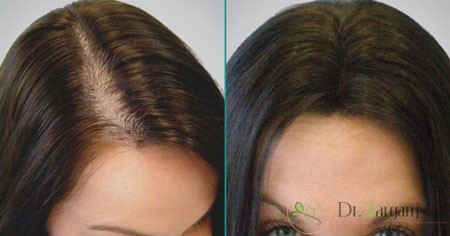 پیوند مو در کلینیک زیبایی به چه صورت انجام می پذیرد؟