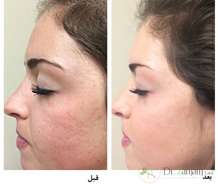 نتیجه کار بعد از لیزر چگونه است؟