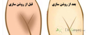 انواع روش های سفید کردن واژن