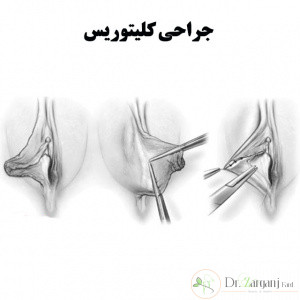مراقبت های بعد از عمل