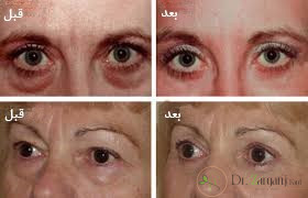 تورم پس از کربوکسی تراپی