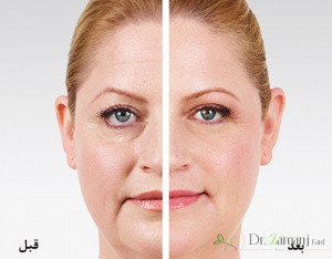 بعد از تزریق ژل چه مشکلاتی وجود دارد؟