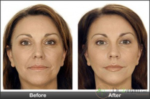 جهت پیشگیری از افتادگی چه راهکارهایی ارائه می شود؟ 