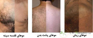 آیا بعد از لیزر کردن فرد از نتیجه راضی است؟