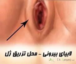 1ـ تزریق ژل به لابیا ماژور چیست؟