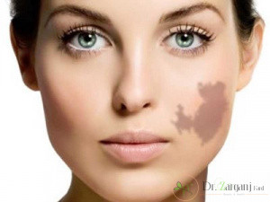 مزایای لیزر پوست برای خال های عروقی و ماه گرفتگی چیست؟