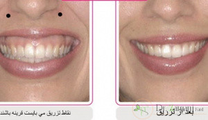 بوتاکس لب بالا و لبخند لثه ای؟