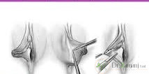 1ـ لابیاپلاستی چیست؟
