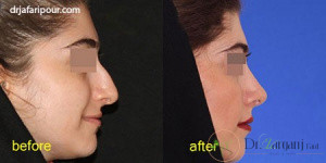 5 اصل قبل از عمل زیبایی بینی