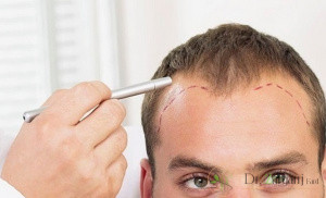 مراقبتهای بعد از عمل