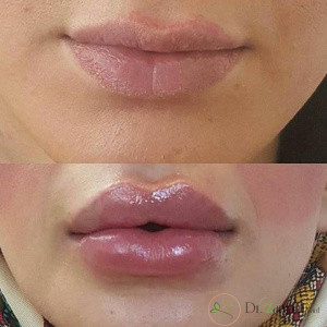 جنس ژل تزریق لب
