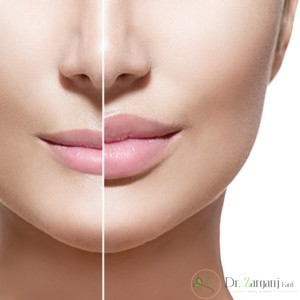 موارد مصرف ژل و بوتاکس های تزریقی صورت ؟