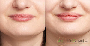 هزینه تزریق ژل لبخند به چه فاکتورهایی وابسته است؟
