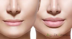 فرم کلی لب ها بعد از تزریق ژل لب