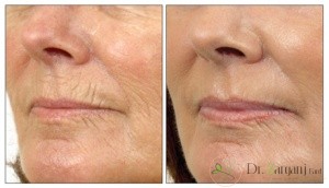 روند درمانی به وسیله ی کربوکسی تراپی چند جلسه به طول خواهد انجامید ؟