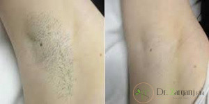 مرکز انتخابی برای لیزر موهای لیزر