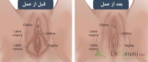 عمل لابیاپلاستی چیست؟