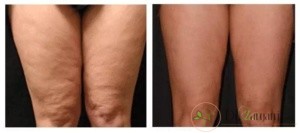 مزایای مزوتراپی چه چیزهایی هستند؟