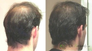 میزان تاثیر مزوتراپی در ترمیم مو چقدر است؟