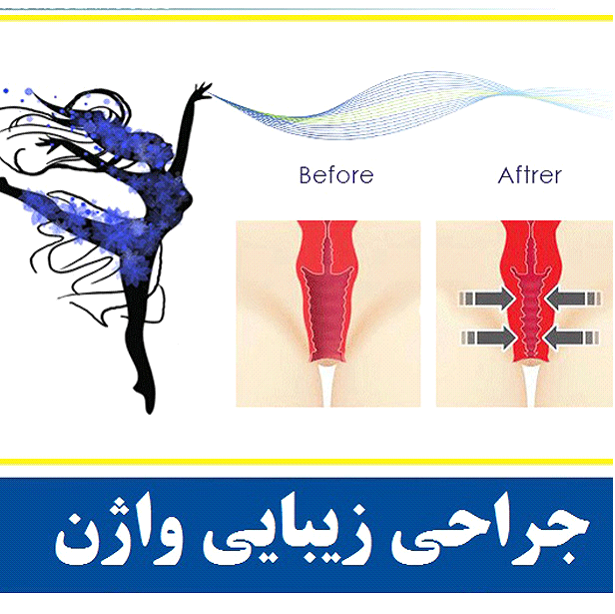 عمل تایتنینگ