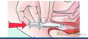 2ـ تزریق ژل به لابیا چه مزایایی دارد؟