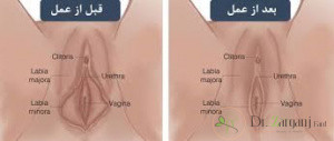 3ـ عمل لابیاپلاستی چه عوارضی دارد؟