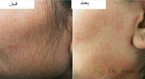 -درباره پیدایش لیز چه می دانید؟
