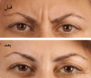 بوتاکس خط اخم