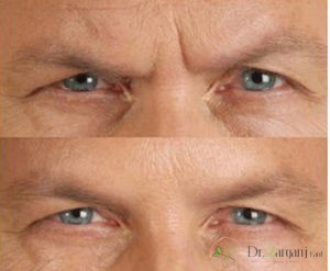 فرق بوتاکس زیبایی با پرکننده های تزریقی مثل چربی